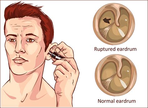 Eustachian Tube Dysfunction Remedies