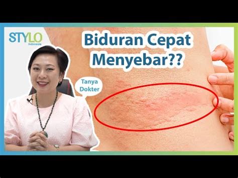 Biduran Bisa Menular Ini Tempat Muncul Cara Penyebaran Penyakit