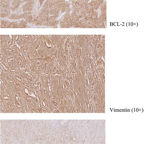 A‐e Pathology Spindle Cell Proliferation Arranged In Short Fascicles