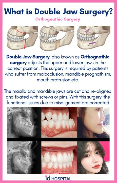 3 month recovery for double jaw surgery – Artofit