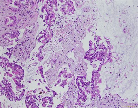 Qiao S Pathology Invasive Mucinous Adenocarcinoma Of The Lung A