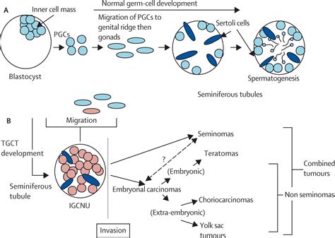 Testicular Germ Cell Cancer The Lancet