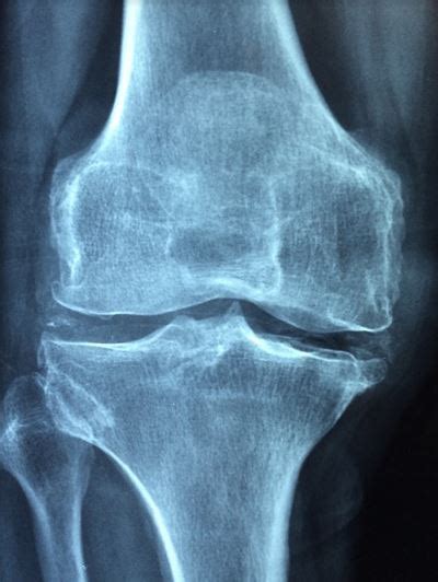 Knee Osteonecrosis Latest Facts: Causes, Diagnosis, Risk Factors ...