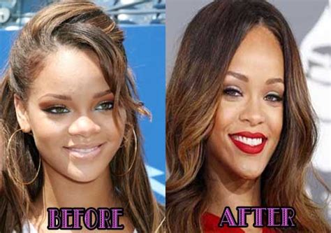 Rihanna Nose Job Plastic Surgery Before And After Pictures 2018