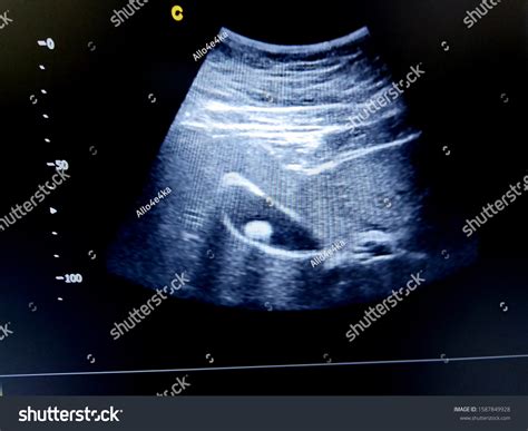 Gallbladder Ultrasound Stones