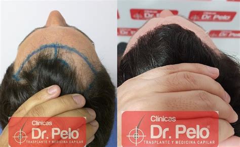 Trasplante Capilar Clinica Dr Pelo Clinicas Dr Pelo Centro