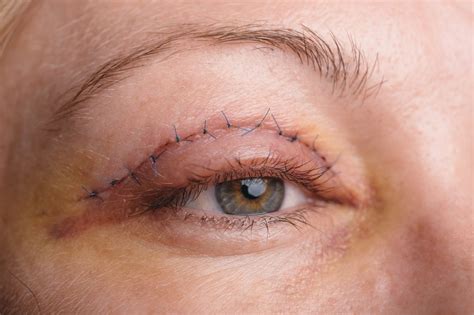 Everything You Need To Know About Droopy Eyelid Surgery Droopy Eyelid