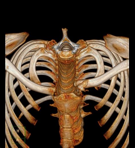 Sternoclavicular Joint Dislocation Image