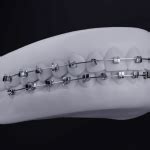 Carriere Slx D Brackets Henry Schein Orthodontics