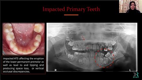 Delayed Tooth Eruption Pathogenesis Diagnosis And Treatment Options And Return To Work Are We