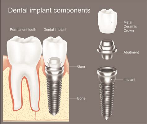 Dental Implants - Procedure, Benefits, Cost and More