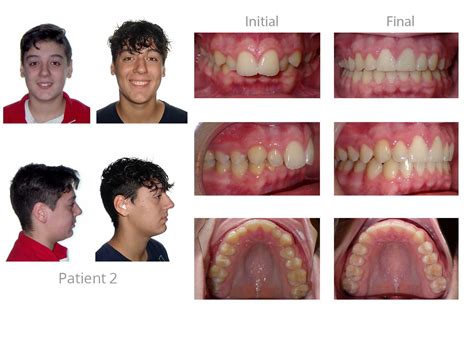 Herbst Appliance Patient 2 After - Orthodontic Arts