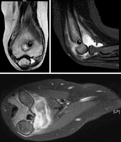 Das intraartikuläre Osteoidosteom SpringerLink