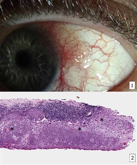 Conjunctival Intraepithelial Neoplasia Ophthalmology