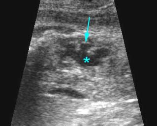 Hydronephrosis Department Of Obstetrics And Gynecology Faculty Of