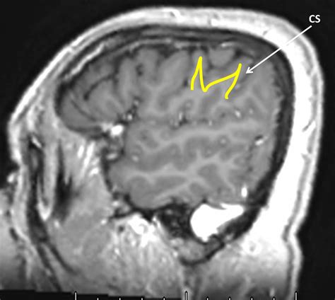 Central Sulcus Radiology Cases