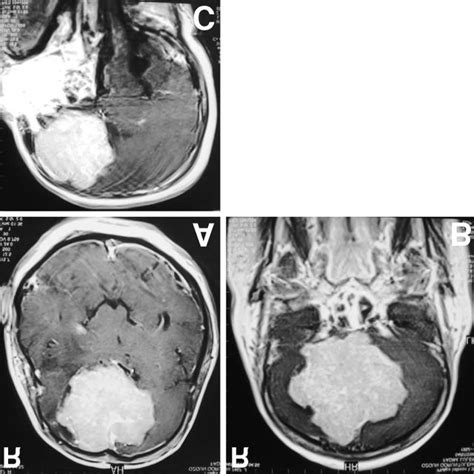 Preoperative Axial A Coronal B And Sagittal C T Weighted