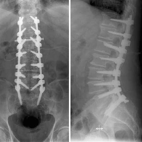 Pdf Sacral Fractures After Multi Segmental Lumbosacral Fusion A Series Of Four Cases And