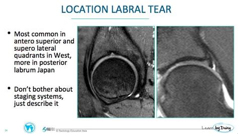 Labral Tear Hip Mri Images