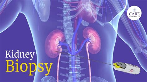 How Is Kidney Biopsy Done Kidney Biopsy Procedure Care Hospitals