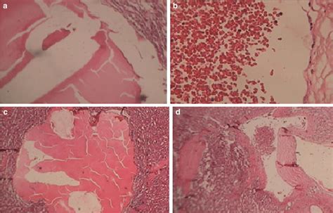 Histopathology Of The Spleen Showed A Large Cavernous Hemangioma Download Scientific Diagram