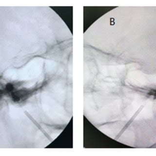 | The Fogarty balloon catheter located at the entrance of the foramen ...