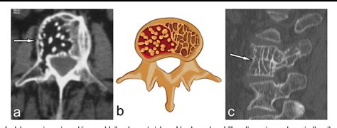 A Systematic Approach To Vertebral Hemangioma Semantic Scholar