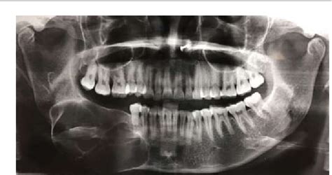 Figure From Odontogenic Keratocyst Okc Or Keratocystic Odontogenic