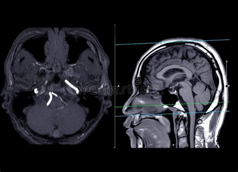 Mra脑轴mip视图显示脑动脉 库存图片 图片 包括有 头疼 头脑的 诊断 医院 健康 神经外科学 252924933
