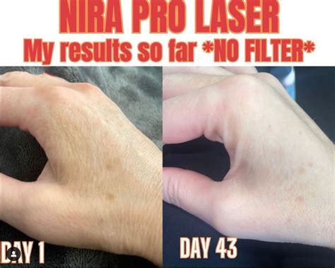 My NIRA Pro Laser Results Before And After Pictures 25 Off Code