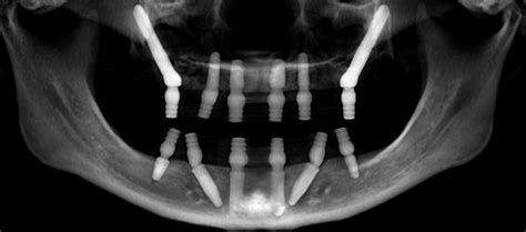 How Do Dental Implants Stay In Place New Teeth Now