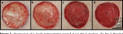 Figure 2 From Comparison Of The Effects Of Different Negative Pressure Wound Therapy Modes