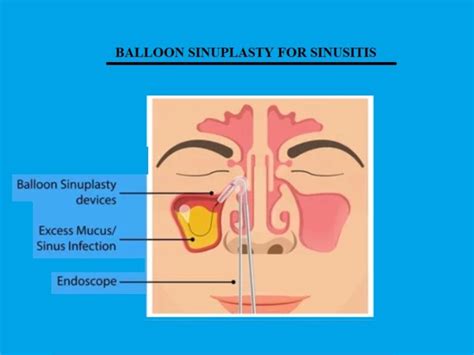 Balloon Sinuplasty For Sinusitis Dr Sharad Ent