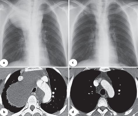 Figure 1 From Mediastinal Lymphangioma Treated Using Endobronchial