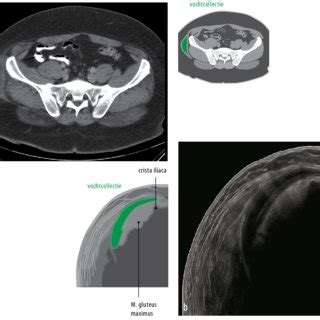 (PDF) The Morel-Lavallée-lesion: Delayed symptoms after trauma