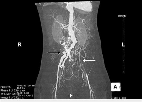 Ct Angiogram Of The Abdomen And Pelvis Angiogram Of The Abdomen And Download Scientific Diagram