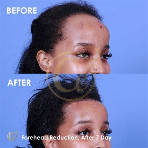 Forehead Reduction Dr Cengizhan Ekizceli