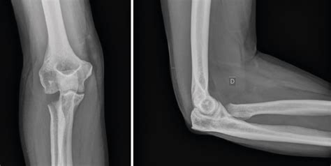 Fracturas Del Extremo Proximal De C Bito Y Radio Fondoscience