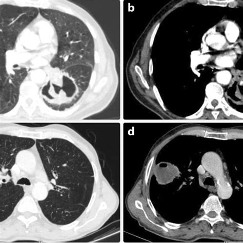 In A And B Thorax Ct Images Of The Cavitary Lesion Located In The