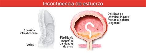 Tipos De Incontinencia Urinaria En Adultos Blog Iberomed