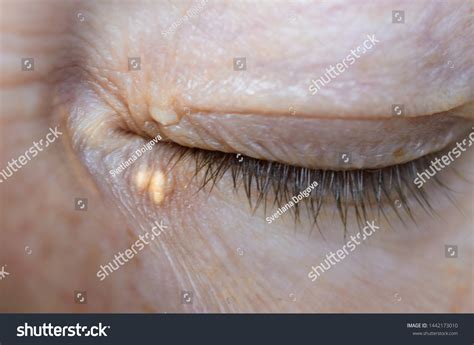 Close Woman Eyes Xanthelasma On Eyelids Stock Photo