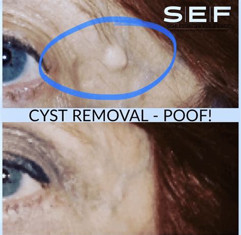 Mole And Cyst Removal Before And After Gallery Schlessinger Eye And Face