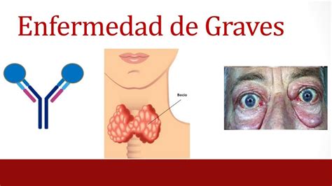 Enfermedad De Graves Basedow