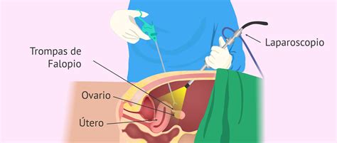 Trompas De Falopio Función Extirpación Y Embarazo Doctor Online