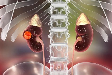 Cancerul Renal Cauze Manifestari Si Optiuni De Tratament Dr Max