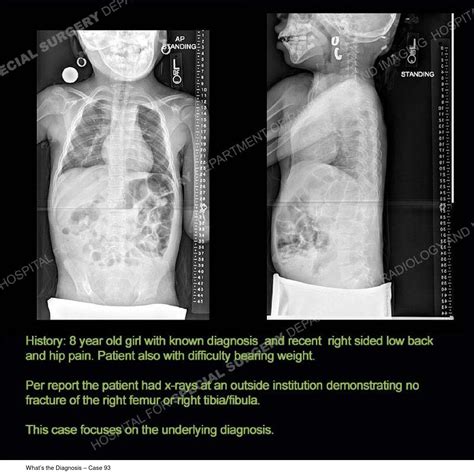 Hss Whats The Diagnosis Case 93 By Hospital For Special Surgery Issuu