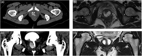 Comparison Of Ct Vcug And Mri In A 42 Year Old Female A The Axial