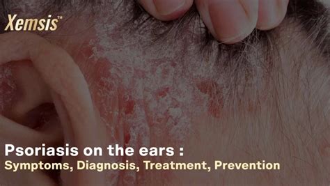 Psoriasis Treatment – XEMSIS