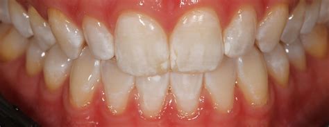 Does Teeth Whitening Cause White Spots on Teeth? - Teeth Whitening Experts NYC