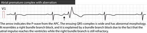 Premature Atrial Contraction Premature Atrial Beat Complex Ecg And